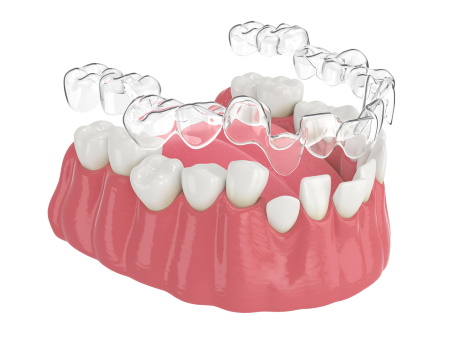Choosing the Best Type of Invisalign Retainer After Treatment – Movemints
