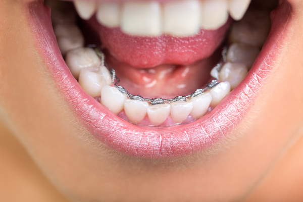 3 Reasons to Consider Clear Braces - Henry Orthodontics Pinehurst