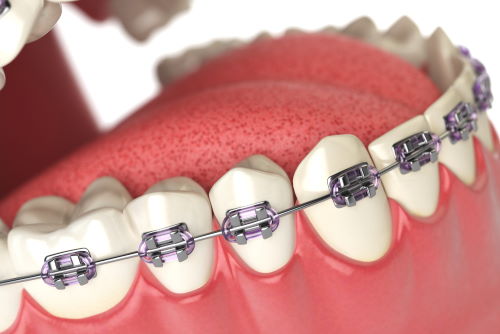 Obesity Influences Orthodontic Treatment in Adolescents – Dentistry Today
